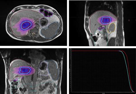 Magnetic Resonanceeguided Stereotactic Ablative Radiation Therapy Plan