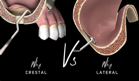 (FREE MASTERCLASS)TRANS-CRESTAL ACCESS IN SINUS LIFT TO AVOID COMPLICATIONS ...