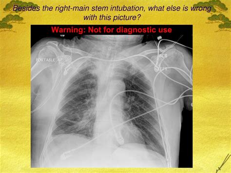 Ppt Gastric Resection General Surgical And Anesthetic Considerations