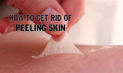 Here’re Useful Tips On How To Get Rid Of Peeling Skin That Help You Say Good Bye To Flaky Dry