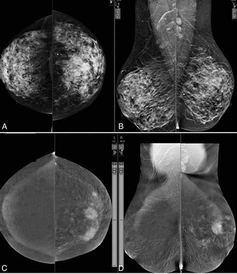 Comparing Standard Mammography To Contrast Enhanced Dual Energy Digital