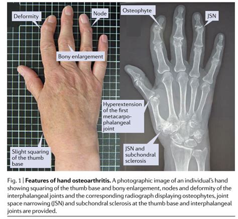 Evaluaci N De La Mano Con Artrosis Y Rizartrosis Recomendaciones