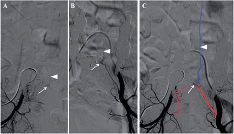 Preoperative Spinal Angiography Selective Spinal Angiography Of The