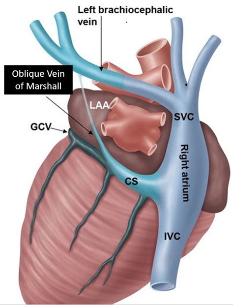 Vein Of Marshall Scrubbed In My 1st AFib Ablation Vein Of Marshall