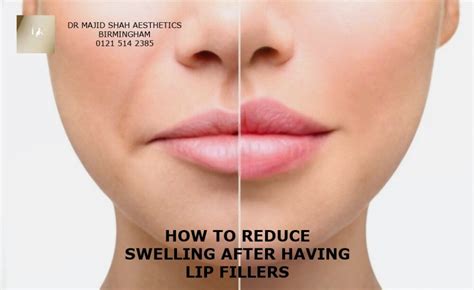 Lip Filler Swelling Stages Lip Injections Dr Majid Shah