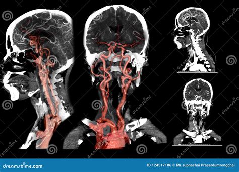 Multi View 2d And 3d Rendering Image Of Ct Angiography Stock