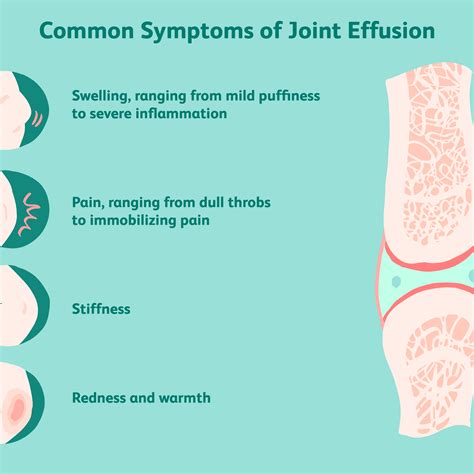 Joint Effusion Treatment