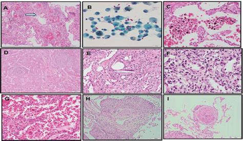 Photomicrograph Showing Important Histological Findings A Acute