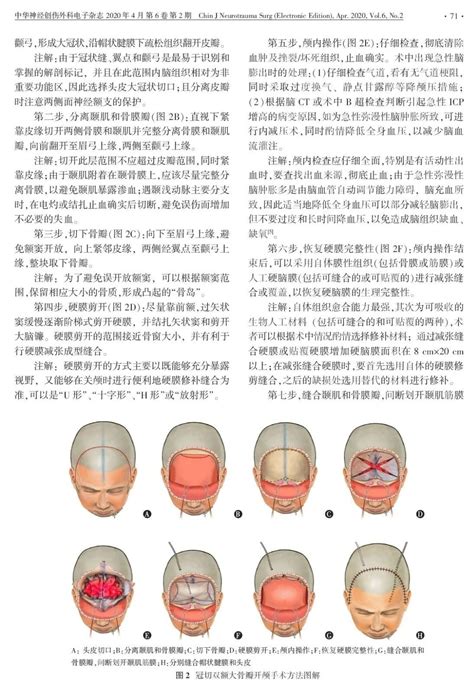 中国成人重型颅脑损伤大骨瓣开颅手术标准技术专家共识（2020） 脑医汇 神外资讯 神介资讯