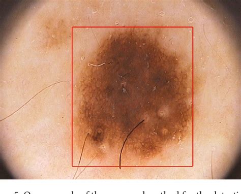 Figure 5 From A Segmentation Of Melanocytic Skin Lesions In Dermoscopic