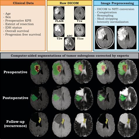 RHUH GBM The Cancer Imaging Archive TCIA