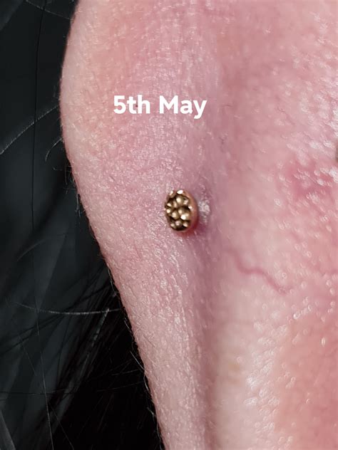 Irritation Bump Getting Worse R Piercing