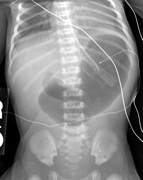 Midgut Volvulus X Ray