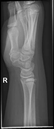 Normal Wrist X Ray Lateral