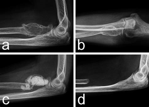 A B Lateral And Ap View Of An Aggressive Gctb Of The Proximal Radius