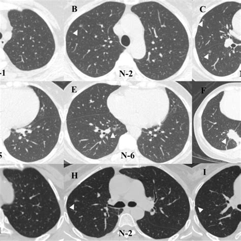 Chest Ct Scan Finding Of The Patient A F The Right Upper Lobe Shows Download Scientific