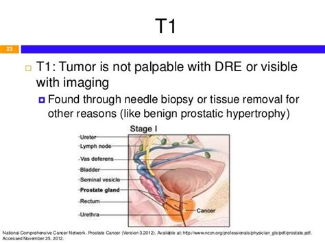 Overview And Pharmacotherapy Of Prostate Cancer Based On Nccn 2012 G