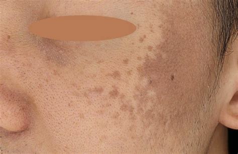 Nevus Of Ota What Is It And How Is It Treated White Aesthetics