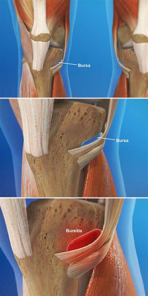 Goosefoot Pes Anserine Bursitis Of The Knee Orthoriverside