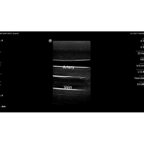 Blue Phantom Gen Ii Femoral Vascular Access And Regional Anesthesia Ultrasound Training Model In