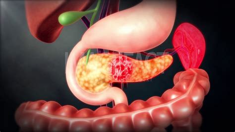 Pancreatic Cyst Types