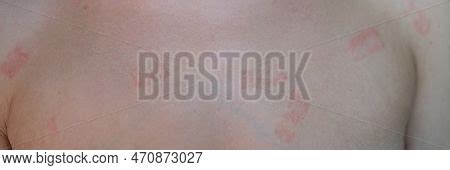 Red Itchy Patch Rash Image & Photo (Free Trial) | Bigstock