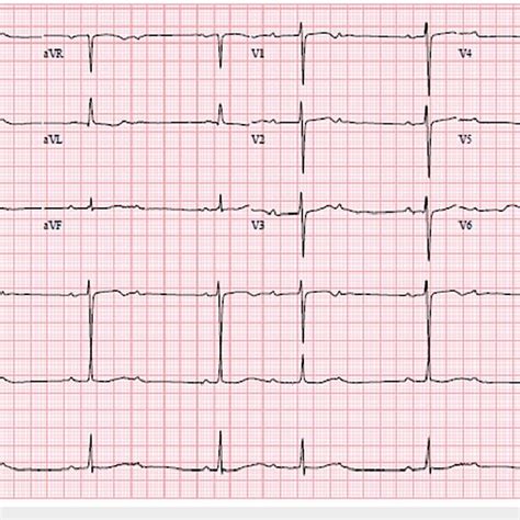 Second degree, Mobitz type 1 AV block | Download Scientific Diagram