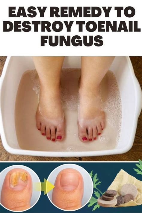 Real Cause Of Toenail Fungus Artofit