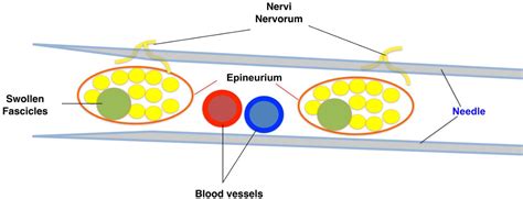 Figure 1 From Ultrasound Guided Nerve Hydrodissection For Pain Management An Updated Review Of