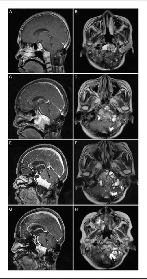 Figure From Lymphoplasmacyte Rich Meningioma With Atypical