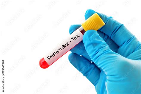 Blood Sample Tube For Western Blot Test Confirmatory Test For Hiv