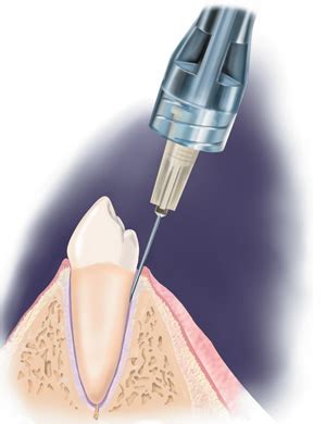 Medicaldental Studio Dentistico Anestesia Indolore