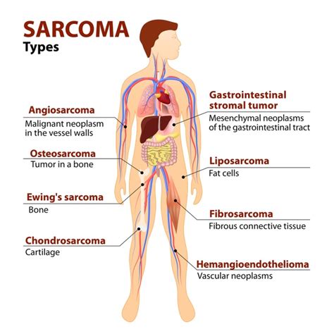 sarcoma types diagram - NFCR