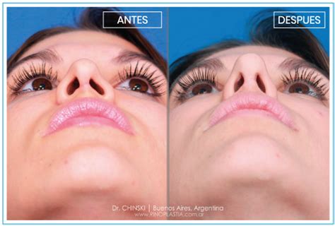 Rinoplastía Secundaria Rinoplastia Dr Chinski