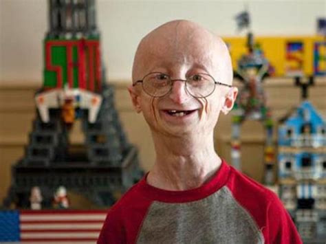 Progeria La Rara Enfermedad Que Acelera El Proceso De Envejecimiento