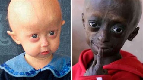 Qué Es La Progeria La Enfermedad Mortal Que Acelera El Envejecimiento