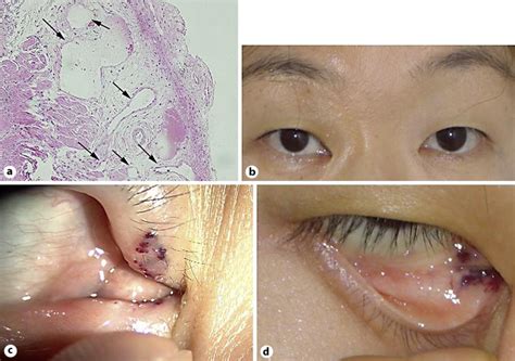 Figure 1 From Topical Treatment For Orbital Capillary Hemangioma In An