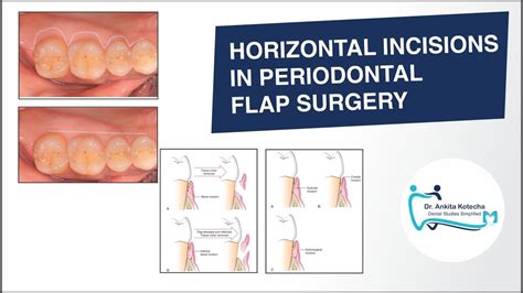 Types Of Flap In Periodontal Surgery - Design Talk