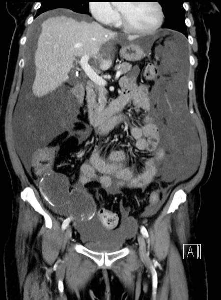 Ruptured Appendiceal Mucocele With Pseudomyxoma Peritonei R Radiology