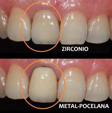 ¿Coronas de zirconio o de porcelana? | RESYCAM - TODO PARA CAD/CAM