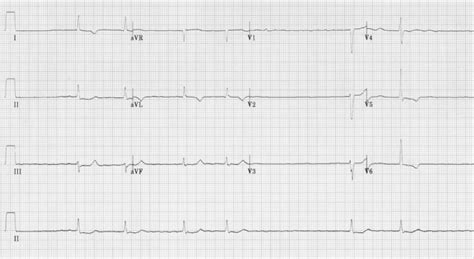 Atrial Fibrillation Litfl Ecg Library Diagnosis