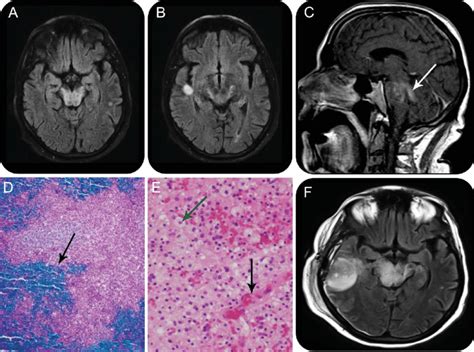 Figure Mri And Histology Of Demyelinating Lesion Download Scientific Diagram