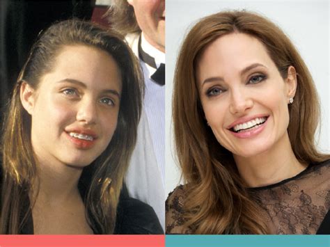 Orthodontics Australia | 6 Celebrities With Braces Before and After ...