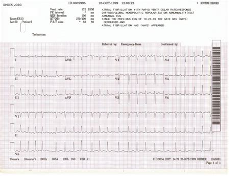 Atrial Fibrillation Ekg Examples Wikidoc