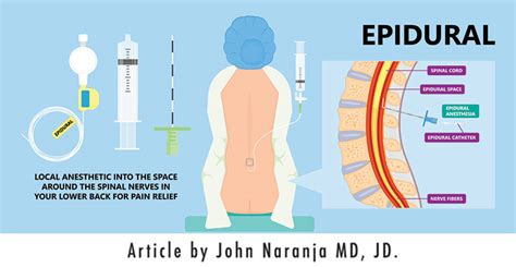 Ask Dr John Esq. - What Are Epidural Steroid Injections? - Diller Law ...