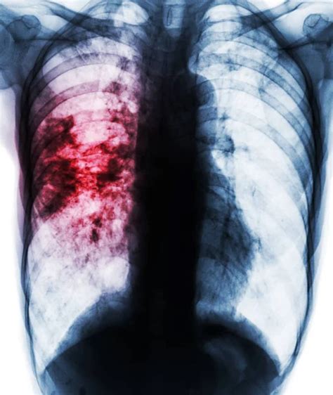 Pulmonary Tuberculosis Chest X Ray