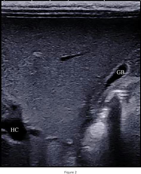 Figure 2 From The Prognosis Of Type III Biliary Atresia With A Hilar