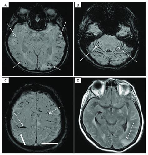 Resonancia magnética cerebral cortes axiales A Secuencia SWI muestra