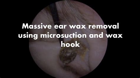 Massive Blockage Of Ear Wax Removed Using Microsuction And S Barts Hook