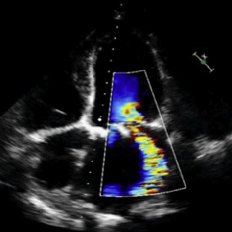 Imagen de ecocardiografía transtorácica en la que se aprecia